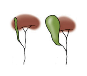 Figura 3. Vie biliari extra-epatiche completamente ostruite; la colecisti può essere più o meno coinvolta dal processo di fibrosi.