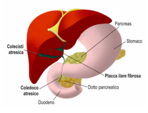 Figura 2. Sono raffigurate le stesse strutture in un bambino con atresia delle vie biliari.