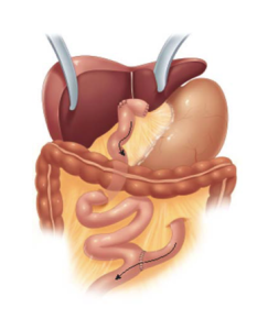 Figura 5. Intervento di Kasai di tipo I. Dopo l’eliminazione dei dotti biliari ostruiti l’ansa intestinale viene raccordata direttamente al fegato. 