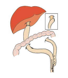 Figura 7. L’ansa intestinale viene raccordata ai dotti pervi.
