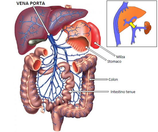 Fig.1: Situazione normale: la vena porta raccoglie il sangue proveniente dall’intestino, dallo stomaco, dal pancreas (non rappresentato) e dalla milza e lo porta all’interno del fegato. Nel riquadro rappresentazione schematica.