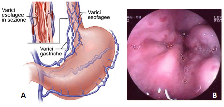 Fig.3: A: Rappresentazione grafica delle varici esofagee. B: Varici esofagee: visione endoscopica