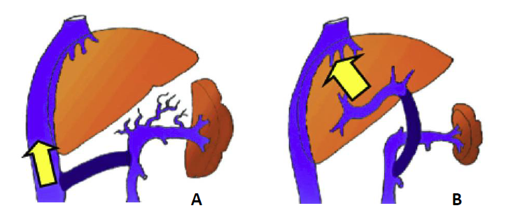 Fig.5: A: Shunt porto-sistemico: il sangue del sistema portale viene deviato in una vena della circolazione sistemica (nello schema la vena cava) e “scavalca” il fegato. B: Shunt Mesenterico-portale: il sangue del sistema portale viene deviato in una vena del fegato, ripristinando il normale flusso intraepatico